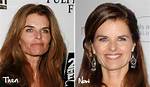 Doctors Have Claimed That Maria Shriver Has Had a Facelift