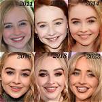Exploring Sabrina Carpenter's Cheek Filler Transformation