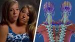 Exploring the Fascinating Anatomy of Conjoined Twins Abby and Brittany