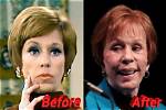 Uncovering Carol Burnett's Plastic Surgery Journey