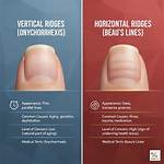 Unveiling the Mystery: What Causes Horizontal Ridges in Fingernails?