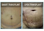 Unveiling the Secrets of Kidney Transplant Scars: a Journey to Recovery